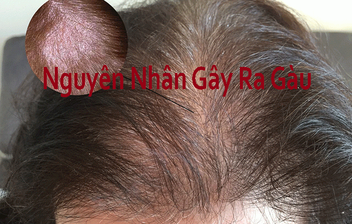 Nguyên Nhân Gây Ra Gàu