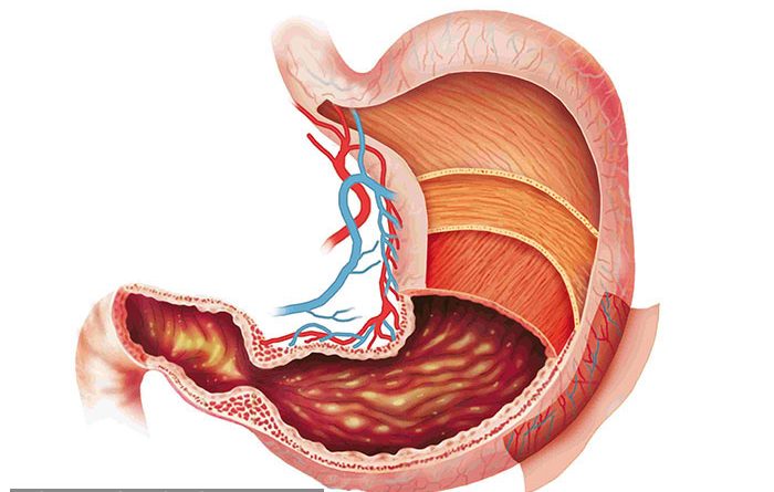 Đau Dạ Dày Cấp